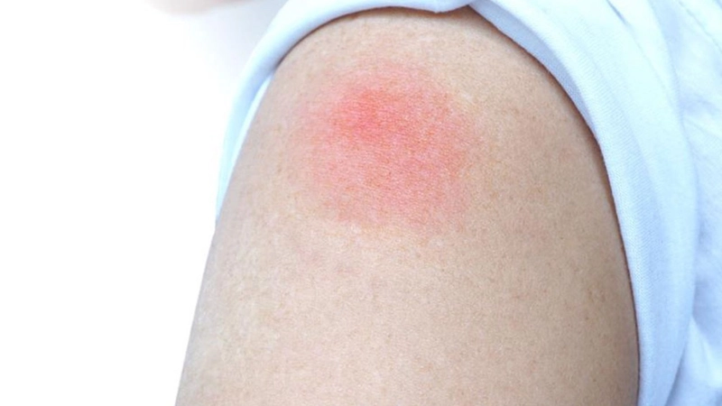 Vết tiêm phòng bị sưng cứng lâu ngày có sao không?